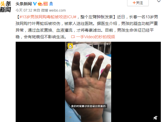 13歲男孩網購毒蛇被咬進ICU 整個左臂腫脹發紫